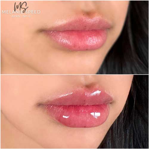 Lip Augmentation by Flawless Medspa