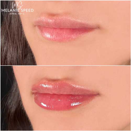 Lip Augmentation by Flawless Medspa