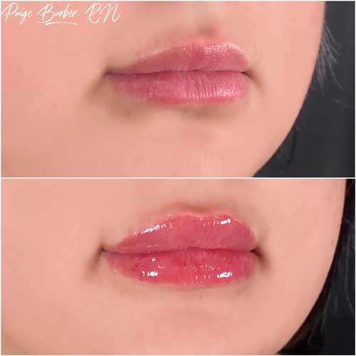 Lip Augmentation by Flawless Medspa