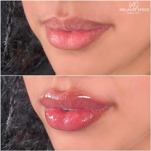 Lip Augmentation by Flawless Medspa