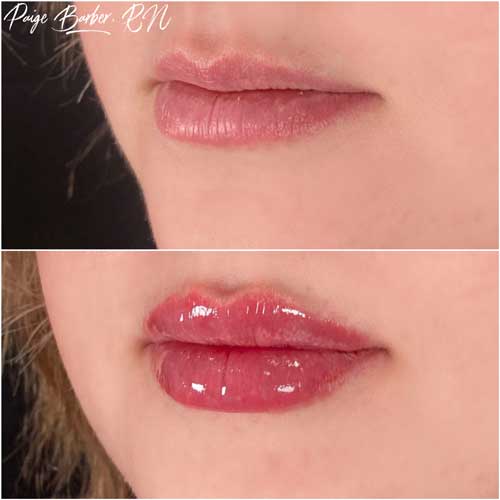 Lip Augmentation by Flawless Medspa