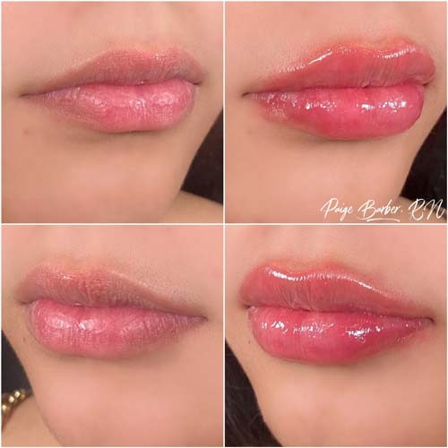 Lip Augmentation by Flawless Medspa