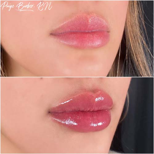 Lip Augmentation by Flawless Medspa