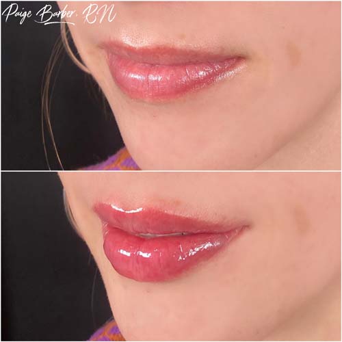 Lip Augmentation by Flawless Medspa