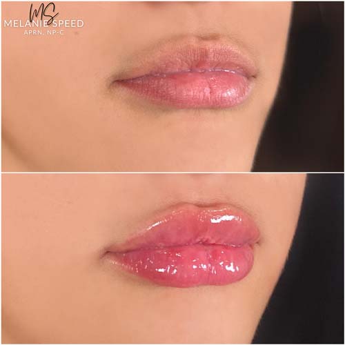 Lip Augmentation by Flawless Medspa