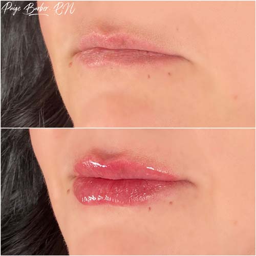 Lip Augmentation by Flawless Medspa