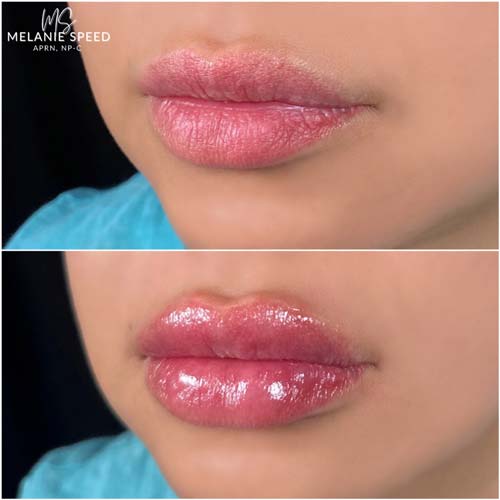 Lip Augmentation by Flawless Medspa