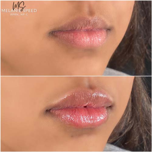 Lip Augmentation by Flawless Medspa