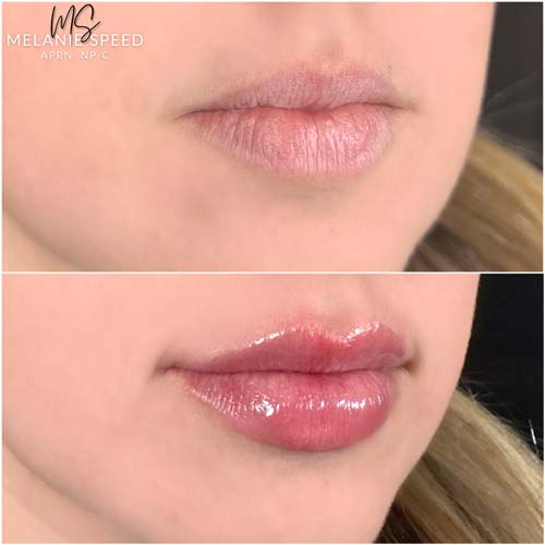 Lip Augmentation by Flawless Medspa