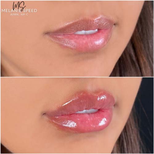 Lip Augmentation by Flawless Medspa