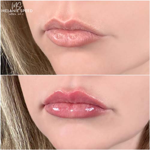 Lip Augmentation by Flawless Medspa