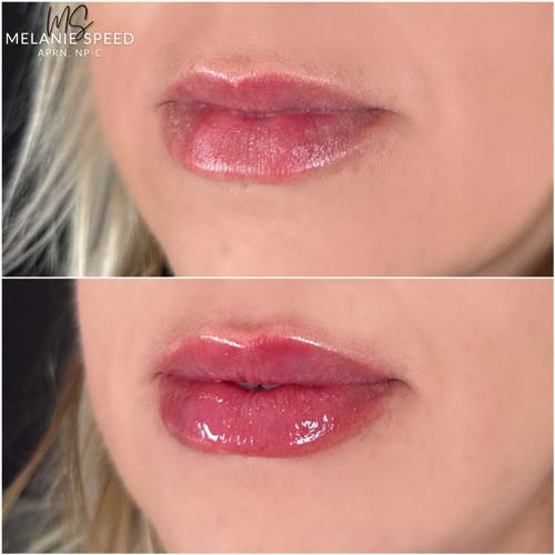 Lip Augmentation by Flawless Medspa