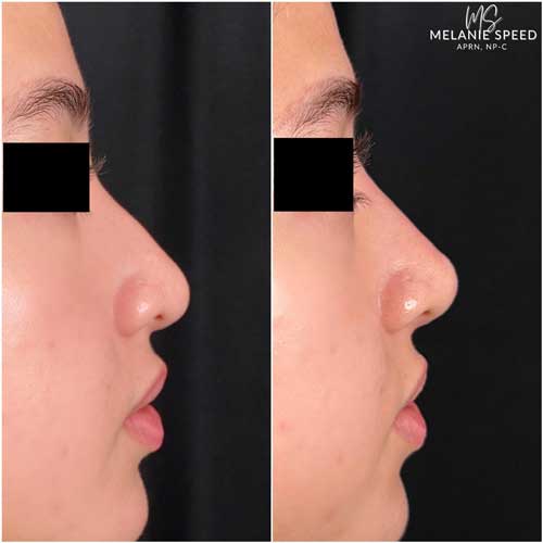 Nose Correction by Flawless Medspa