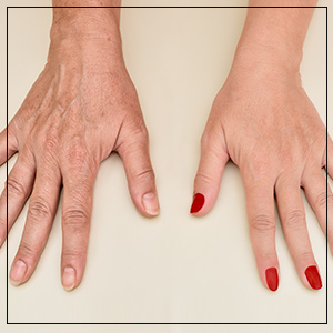 Hand Rejuvenation Treatment Specialist Near Me in Las Vegas NV