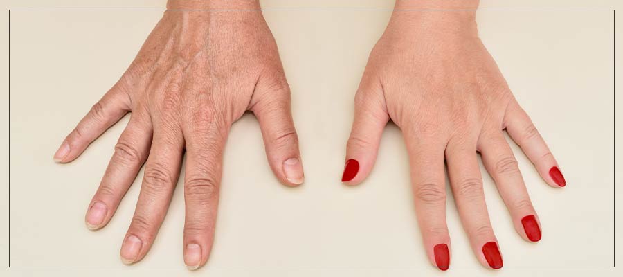 Hand Rejuvenation Treatment Specialist Near Me in Beverly Hills, CA and Las Vegas, NV Hand Rejuvenation Treatment Specialist Near Me in Beverly Hills, CA and Las Vegas, NV