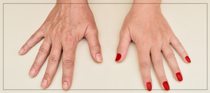 Hand Rejuvenation Treatment Specialist Near Me in Las Vegas, NV