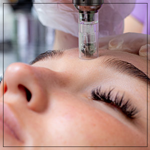 Microneedling Treatment Specialist Near Me in Beverly Hills, CA and Las Vegas, NV
