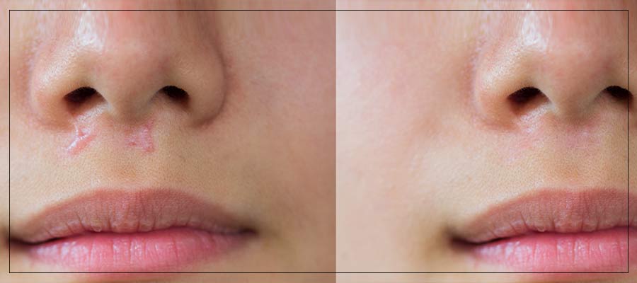 Scar Reduction Treatment Specialist Near Me in Beverly Hills, CA and Las Vegas, NV Scar Reduction Treatment Specialist Near Me in Beverly Hills, CA and Las Vegas, NV
