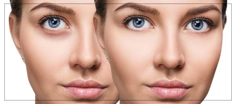 Under Eye Filler Specialist Near Me in Las Vegas NV