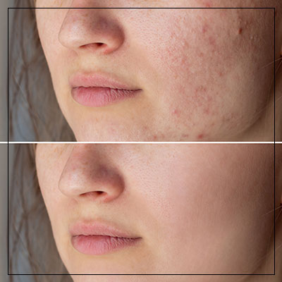 Scar Reduction Treatment Near Me in Las Vegas, NV Scar Reduction Treatment Near Me in Las Vegas, NV