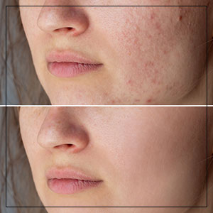 Scar Reduction Treatment Near Me in Las Vegas, NV Scar Reduction Treatment Near Me in Las Vegas, NV