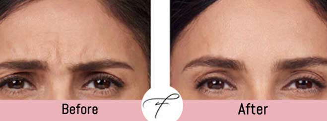 Frown Lines Correction by Flawless Medspa in Las Vegas, NV