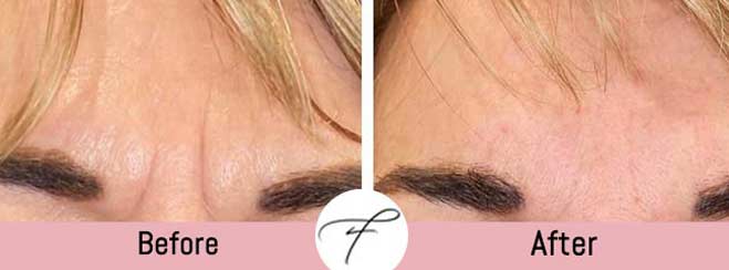 Frown Lines Correction by Flawless Medspa in Las Vegas, NV