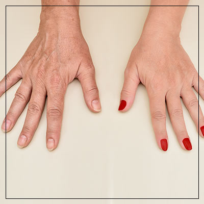 Hand Rejuvenation Specialist Near Me in Las Vegas, NV