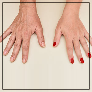 Hand Rejuvenation Specialist Near Me in Las Vegas, NV Hand Rejuvenation Specialist Near Me in Las Vegas, NV