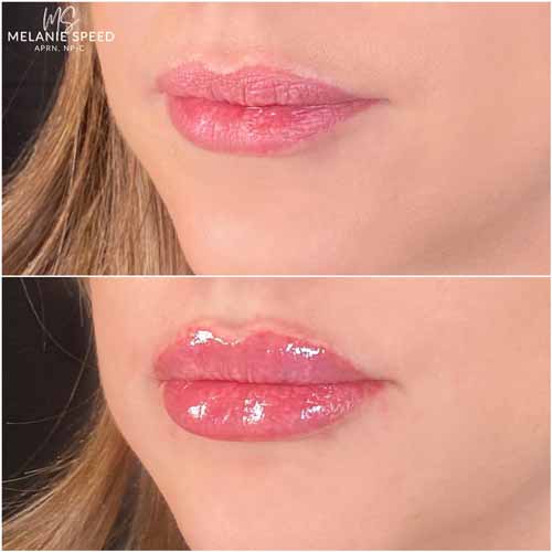 Lip Augmentation by Flawless Medspa