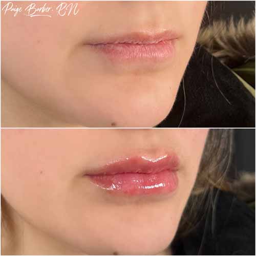 Lip Augmentation by Flawless Medspa