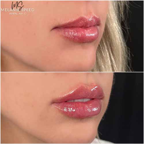 Lip Augmentation by Flawless Medspa