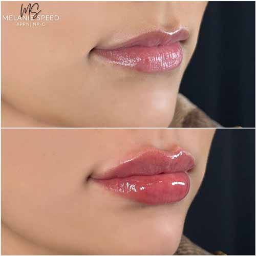 Lip Augmentation by Flawless Medspa