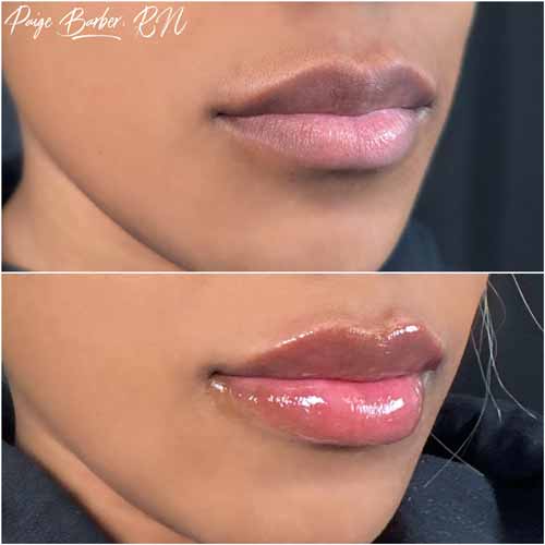 Lip Augmentation by Flawless Medspa