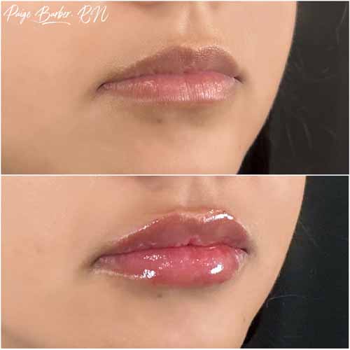 Lip Augmentation by Flawless Medspa