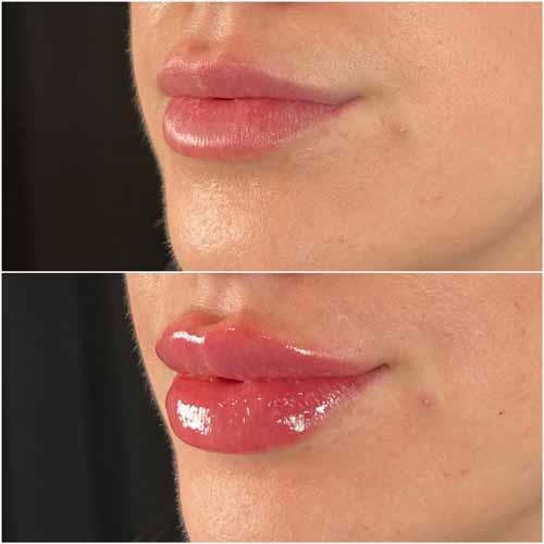 Lip Augmentation by Flawless Medspa