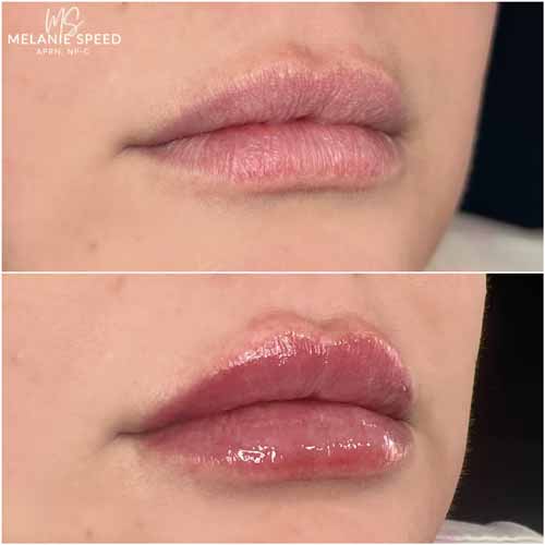 Lip Augmentation by Flawless Medspa