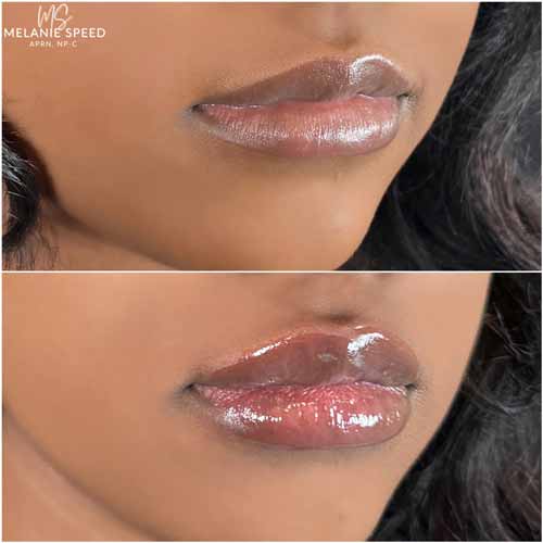 Lip Augmentation by Flawless Medspa