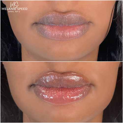 Lip Augmentation by Flawless Medspa