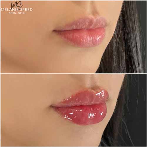 Lip Augmentation by Flawless Medspa