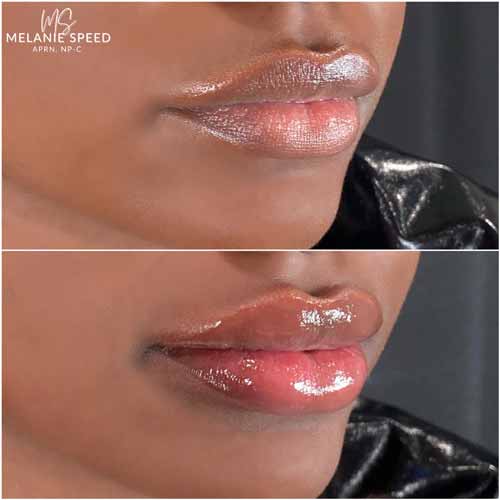 Lip Augmentation by Flawless Medspa