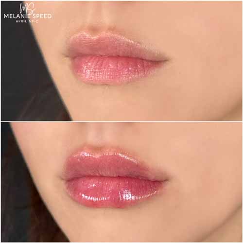 Lip Augmentation by Flawless Medspa