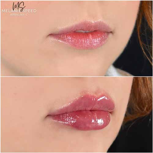 Lip Augmentation by Flawless Medspa