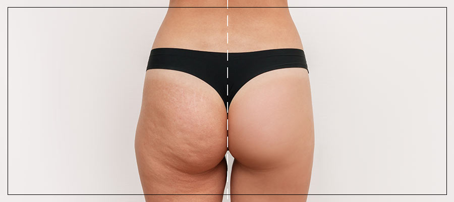 Microneedling Booty Specialist Near Me in Las Vegas NV