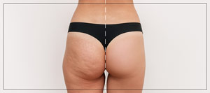 Microneedling Butt Lift Specialist Near Me in Beverly Hills, CA and Las Vegas, NV Microneedling Butt Lift Specialist Near Me in Beverly Hills, CA and Las Vegas, NV