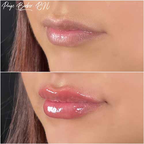 Lip Augmentation by Flawless Medspa