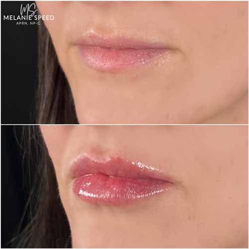 Lip Augmentation by Flawless Medspa