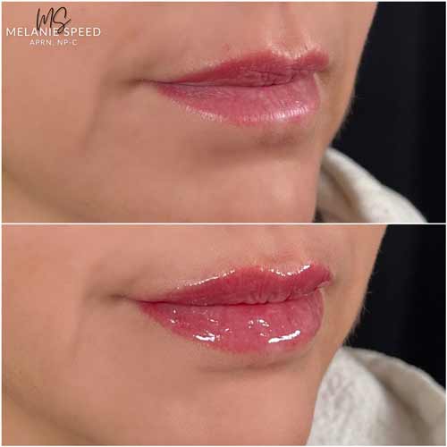 Lip Augmentation by Flawless Medspa