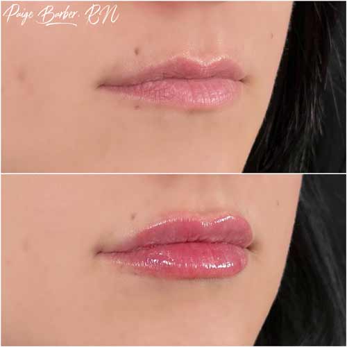 Lip Augmentation by Flawless Medspa