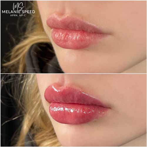 Lip Augmentation by Flawless Medspa